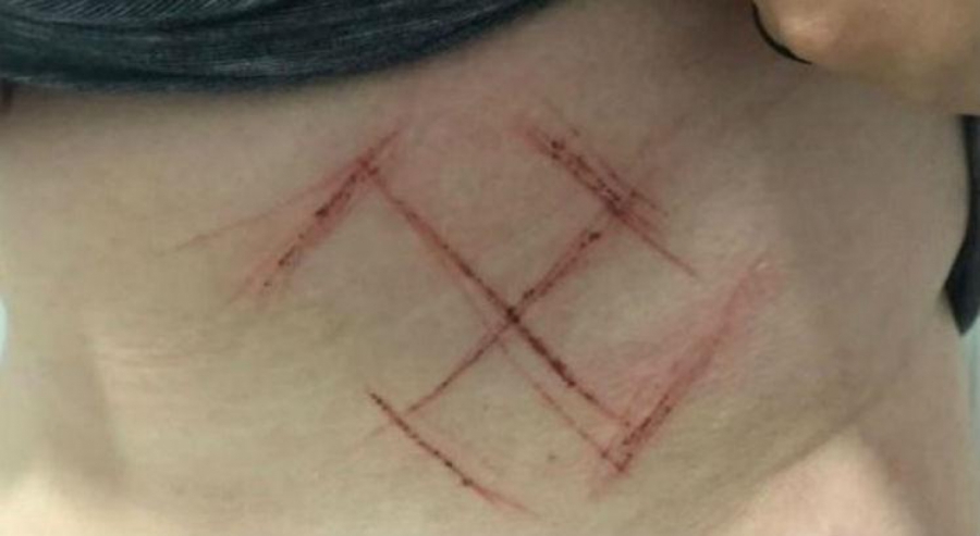 Marca de suástica em jovem foi autolesão, diz polícia