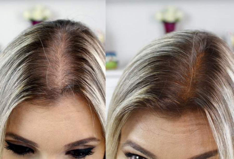 Queda de cabelo é problema para você?